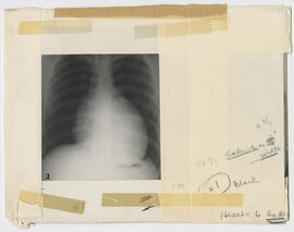 Illustration, p. 110: “Pericardiectomy for Relief of Chronic Constrictive Pericarditis” X-ray image