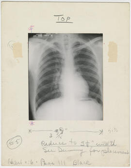 Illustration, p. 111: “Pericardiectomy for Relief of Chronic Constrictive Pericarditis” X-ray image